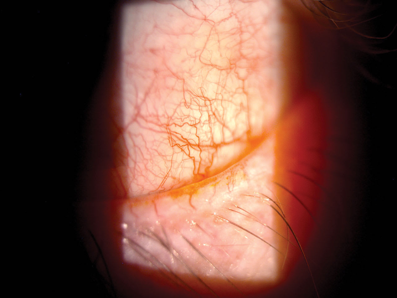 Poor meibum quality, shown here, falls under Category 1 of the TFOS DEWS III report, ocular surface abnormalities. (Photo courtesy: Lisa Hornick, OD, MBA, FAAO)