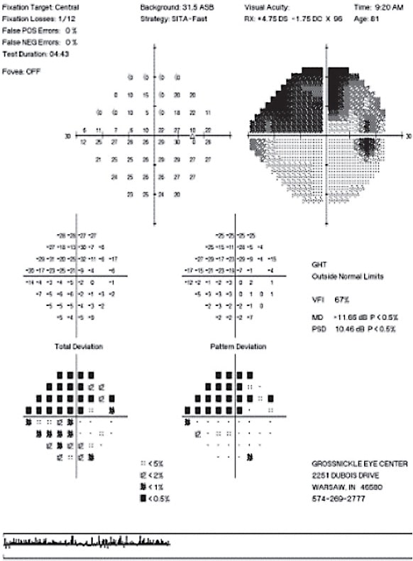 Figure 2. VF shows a reliable, progressive and dense superior nasal/central defect OD, requiring a different treatment approach. 
Images courtesy of Dr. Austin Lifferth