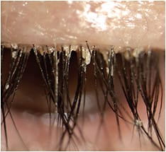 MGD can worsen tear film instability.Image courtesy of Tarsus Pharm.