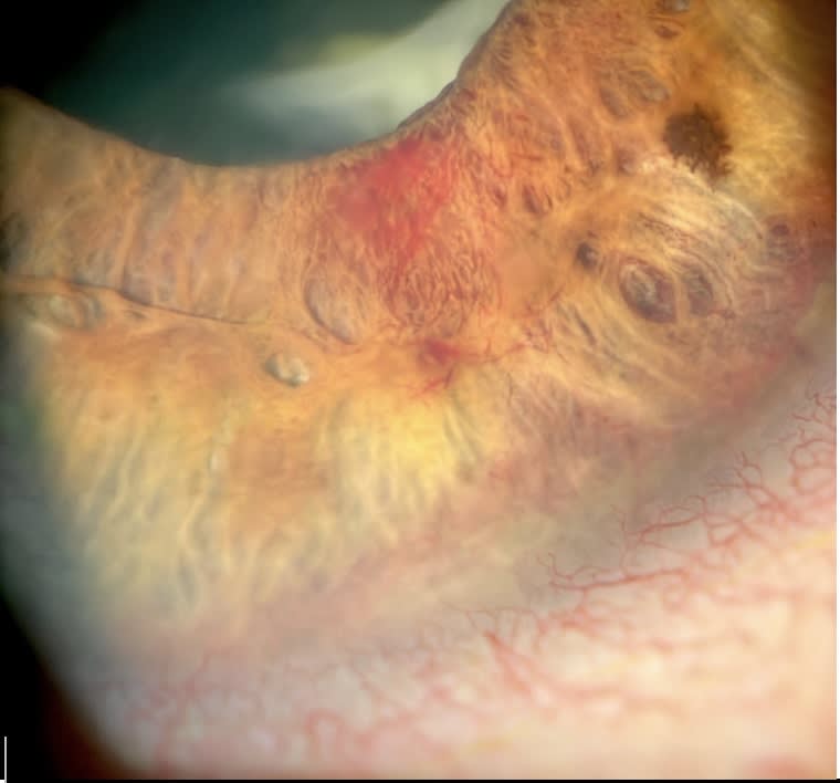 This was a case of neovascularization of the iris and angle secondary to poorly controlled diabetes. (Photo courtesy: Dr. Shah)