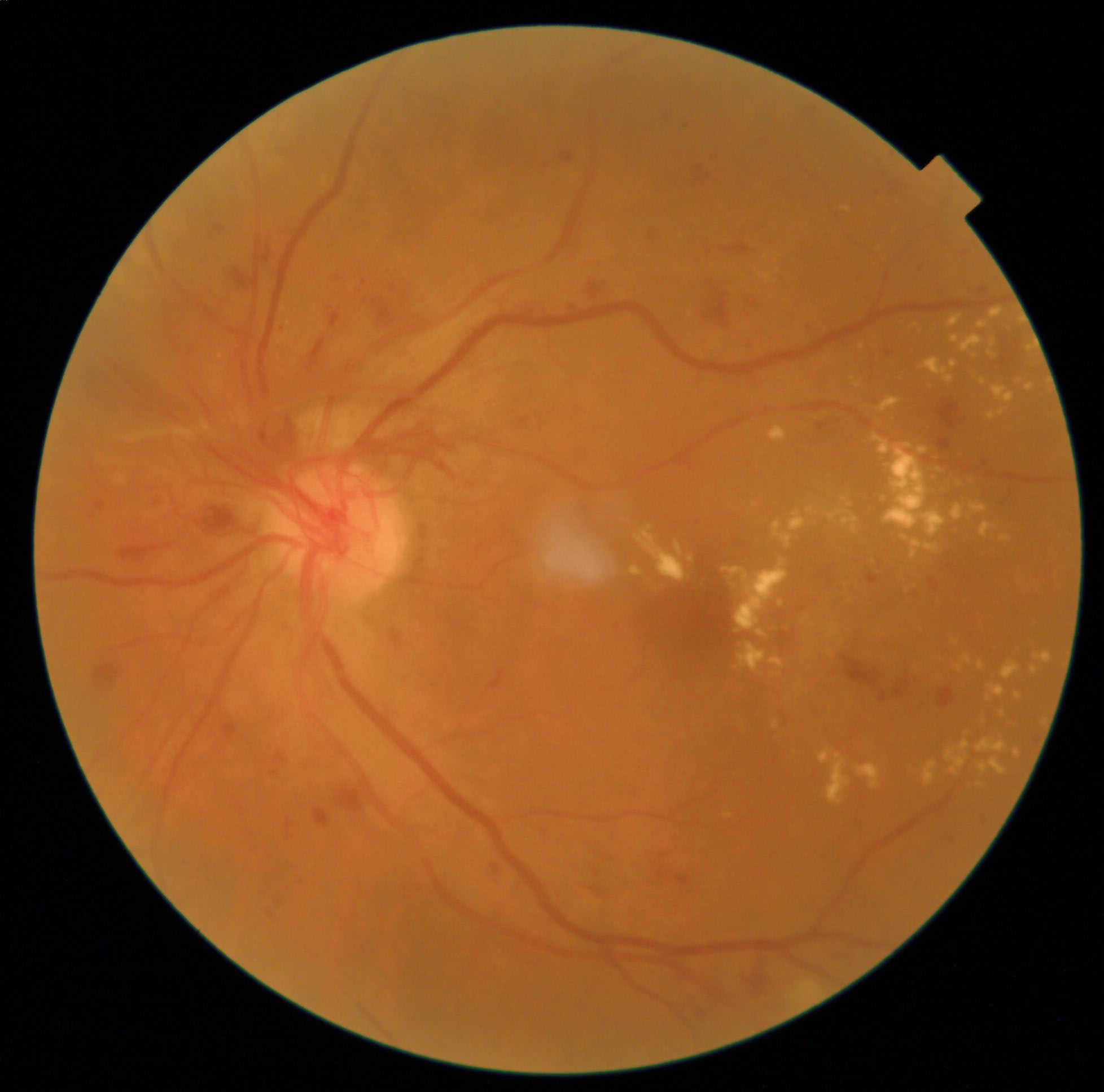 Note these hallmark features of high-risk proliferative diabetic retinopathy, including neovascularization of the disc and diabetic macular edema. (Photo courtesy: Dr. Shah)