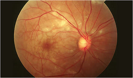 Note the acute central retinal artery occlusion in this 89-year-old female.
Courtesy of Dr. Sherrol A. Reynolds