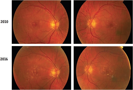 Figure 6. A 74-year-old male was diagnosed with moderate AMD in 2010 and was advised to take an AREDS nutritional supplement, which he neglected to do. He did not return for an examination until 5 years later (2016). At that time, his visual acuity was 20/30 in each eye.