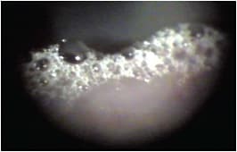 Figure 6. Saponification is a sign of severe tear film instability.