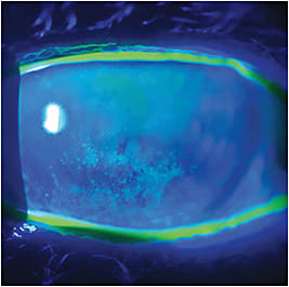 Corneal staining shows DED.
Photo courtesy of Vin Dang, O.D.