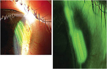 Linear corneal abrasion in 10-year-old. Images courtesy of Dr. Jason R. Miller.