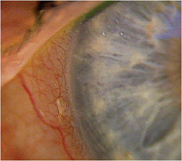 Nasal stent not visible OS.Image courtesy of Dr. Lifferth.