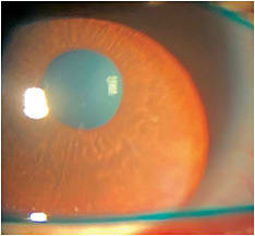 Pre-fitting evaluation with LG. Photo courtesy of Dr. Susan A. Resnick.