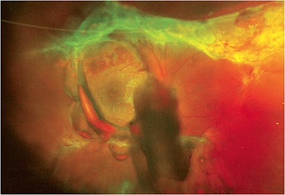 High-risk proliferative diabetic retinopathy (PDR), tractional retinal detachment, and vitreous hemorrhage in a 52-year-old Black female.Image courtesy of Dr. Mohammad Rafieetary.