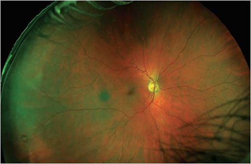 Figure 2. Ultra-widefield optomap revealed degeneration in the retinal periphery.