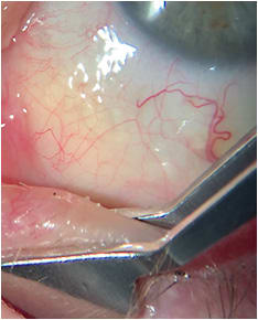 Here, meibomian gland expression reveals moderately turbid and caseous expression nasally.Photo courtesy of Dr. Cecelia Koetting.