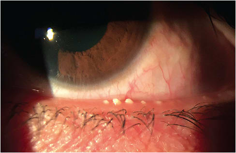 Note the meibomian gland obstruction with telangiectasia in this DED patient.Photo courtesy of Dr. Selina R. McGee.