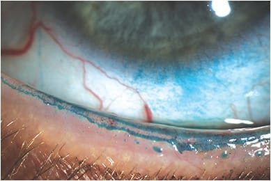Dry eye disease may be on the rise due to increased screen use. Image courtesy of Dr. Hauser