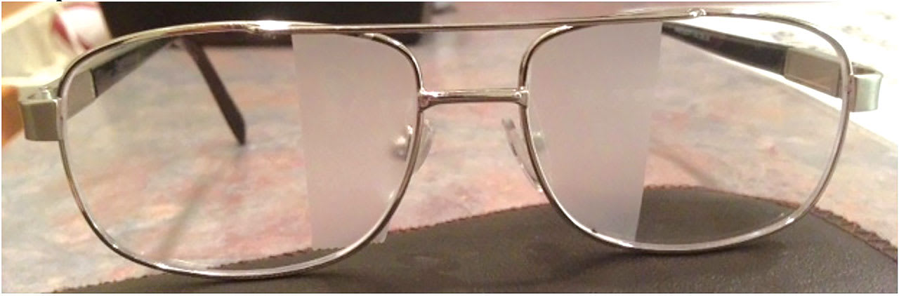 Binasal occlusion can improve visual motion sensitivity symptoms. (Photo courtesy: Dr. Erickson)