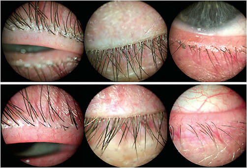 Figure 1. Images from before (upper) and after (lower) treatment. Dry eye management that included lid-hygiene measures helped to prepare this patient for success in very moist, comfortable, multifocal contact lenses.