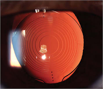 Figure 2. The Symfony toric IOL. PHOTO COURTESY OF AARON BRONNER, OD.