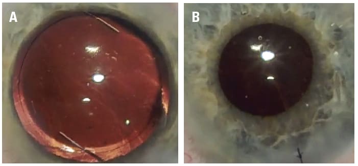 Figure 2. (A) Three-piece IOL placed in the sulcus. (B) Three-piece IOL in the sulcus. Acetylcholine and intracameral moxifloxacin have been placed, and a 10-0 Nylon suture is securing the wound.
