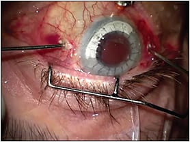 Figure 6. External view of an eye with moderately hazy corneal graft inhibiting microscope view of the posterior segment.