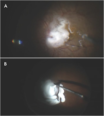 Figure 1. Triamcinolone acetonide injection to visualize vitreous at the beginning of the surgery (A). Triamcinolone acetonide injection at the conclusion of the vitrectomy (B).