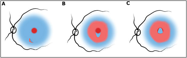 Figure 1. Modification of the inverted internal limiting membrane (ILM) flap technique (ILM hinge or pedunculated flap). Brilliant blue stained ILM with macular hole after initiation of ILM peeling (A). One small flap of ILM is left attached to the hole edge (B). The flap is inverted and made to cover the hole. This can be reinforced by using viscoelastic on top of it (C).