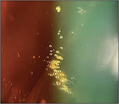 Figure 1. Silicone oil droplets in the vitreous of a patient being examined via slit lamp.