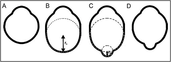 Figure 1. Definition of a posterior staphyloma (modified from reference #2). A. Normal eye shape. B. Axial length elongation occurring in the equatorial region that does not induce any alteration in the curvature of the posterior part of the eye. This eye would have axial myopia, but no staphyloma. C. A second curvature develops in the posterior portion of the eye, and this second curvature has a shorter radius (r2) of curvature than the surrounding eye wall (r1). This secondary curve is due to a staphyloma. D. Posterior staphyloma can also develop in eyes without high axial myopia. The deformity of posterior segment characterized by staphyloma; it therefore, can independently occur from an elongation of the equatorial region.