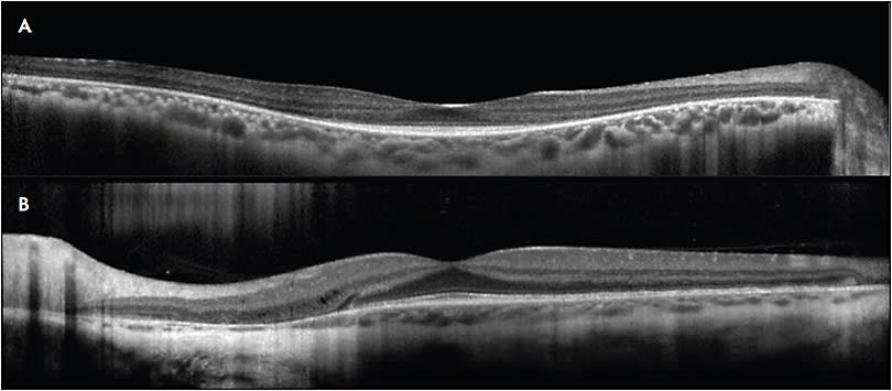 Figure 1.  Spectral-domain OCT image in a patient with retinitis pigmentosa (A) demonstrates the hallmark tapering loss of outer retinal layers in the paracentral macula. There are few acquired diseases that cause such selective outer retinal changes in the absence of prominent collateral damage to the inner retina and RPE. In contrast, OCT imaging in patients with primary choroidal or RPE-based diseases such as choroideremia (B) typically feature abrupt transition zones between healthy and diseased retina, often accompanied by outer retinal tubulations.