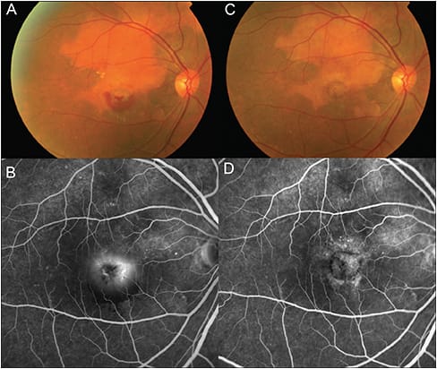 Figure 4. Right eye of a patient with choroidal neovascularization (CNV) associated with choroidal osteoma. Fundus photo showing subfoveal CNV with macular edema at the inferior border of the choroidal osteoma (A). Late-phase FA showed dye leakage from the CNV (B). The patient was treated with ranibizumab injections for 3 months and her visual acuity improved from 20/800 to 20/30. At 1 month after the last ranibizumab injection, a fundus photo showed resolution of macular hemorrhage (C) and late-phase FA showed absence of leakage with fibrosis of the CNV lesion (D).