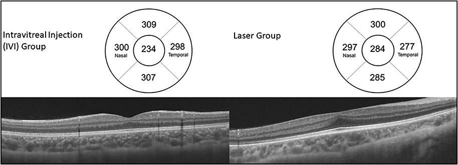Figure 2. Representative macular cross-section scanning of patients with a history of retinopathy of prematurity (ROP) treated with intravitreal injection (IVI) or anti-VEGF. The IVI patient showed a greater depressed foveal contour than that of the lasered patient. In short, patients treated with IVI generally show less foveal hypoplasia than patients treated with laser photocoagulation.