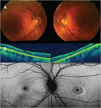 Figure 5. This 65-year-old female was referred with a 2-month history of bilateral blurring of central vision. VA measured 20/30 RE and 20/20 LE. Fundus examination revealed a bilateral bull’s eye pattern of RPE changes and FAF demonstrated a bilateral ring of hypoautofluorescence surrounded by a ring of hyperautofluorescence (Figures A and C). Macular OCT identified parafoveal ellipsoid zone loss along with generalized retinal thinning (Figure B). After additional questioning regarding her current and past medications, she endorsed a 20-year history of hydroxychloroquine use that was stopped several years prior to presentation. Despite no hydroxychloroquine use for a number of years, this patient most likely demonstrated symptomatic progression of hydroxychloroquine toxicity.