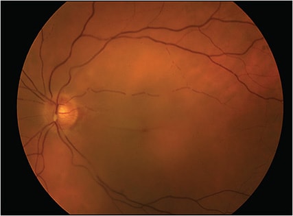 Figure 2. Central retinal artery occlusion (CRAO). Dense, sudden, painless loss of vision in the left eye was experienced by this patient associated with this CRAO. &amp;#x201C;Box-carring&amp;#x201D; (also known as &amp;#x201C;cattle tracking&amp;#x201D; or &amp;#x201C;cattle trucking&amp;#x201D;), clumping of the blood column in the retinal arteries due to stagnant flow, is seen in association with the central retinal arterial embolus.