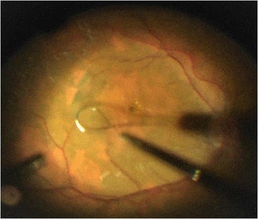 Figure 2. The Finesse Flex Loop (Alcon) is applied to the retinal surface to induce an ILM flap.