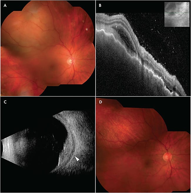 Figure 4. A 58-year-old female presented with right-eye pain, redness, and blurry vision. Fundus examination showed an amelanotic choroidal mass (A). Optical coherence tomography revealed an irregular surface contour with overlying subretinal fluid and vitreous cells (B). B-scan ultrasonography confirmed fluid (arrow) in Tenon’s space (C). Laboratory studies (complete blood count, angiotensin-converting enzyme, lysozyme, QuantiFERON-TB Gold, syphilis antibody, antinuclear antibody, rheumatoid factor, and antineutrophil cytoplasmic antibody) were negative for an underlying systemic inflammatory condition or infectious etiology. The mass and symptoms of redness and pain completely resolved following a course of oral steroids (D).
