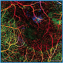 Full-depth color-encoded image taken with the AngioPlex (Zeiss).
Image courtesy of Scott Lee, MD
