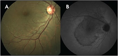 Figure 1. Acute syphilitic posterior placoid chorioretinitis. Note the coarsely stippled hyperpigmentation better outlined on fundus autofluorescence (B). FIGURE REPRINTED WITH PERMISSION FROM ELSEVIER.1