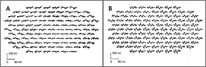 Figure 3. Multifocal ERG demonstrating a severely attenuated response in the right eye (A) and normal waveforms in the left eye (B).
