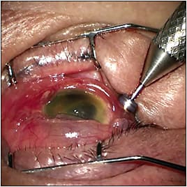 Figure 1. External view of a traumatized eye with a cloudy cornea. The 23-gauge laser endoscope is inserted through a single trocar to assess the ocular interior.