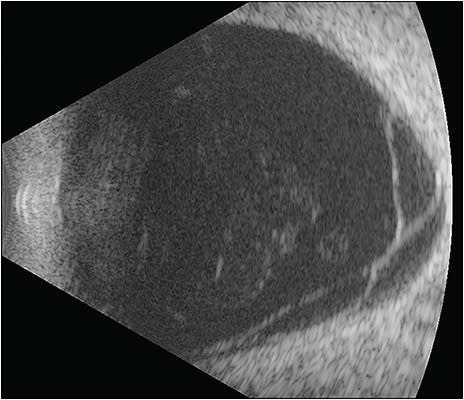 Figure 1.  B-scan ultrasonography demonstrating a localized retinal detachment limited to a large posterior staphyloma caused by a macular hole (not visible in this scan).