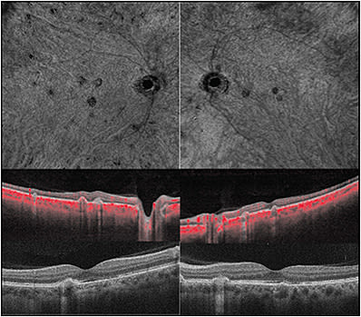 Figure 4. A 36-year-old female who presented as a second opinion regarding choroidal neovascular membrane recalcitrant to multiple anti-VEGF injections demonstrated multifocal lesions with subretinal hyper-reflective material devoid of flow on OCTA.