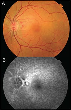 Figure 3. Left eye of a patient with CNV due to angioid streaks. Fundus photo showing peripapillary hemorrhage associated with angioid streaks (A); late-phase fluorescein angiography showing leakage from the CNV (B). The patient underwent anti-VEGF therapy with ranibizumab and his visual acuity improved from 20/25 to 20/20 after treatment.