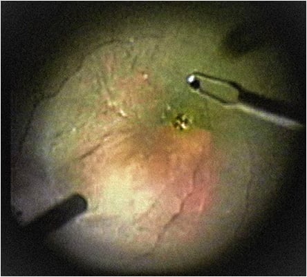 Figure 3. It is preferable to peel ILM as a continuous sheet over the FTMH to avoid leaving remnants that encircle the hole edges.