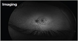 Figure 1: In PPS retinopathy, the fundus autofluorescence demonstrates a highly irregular autofluorescent pattern, surrounded by a peripapillary hypo-autofluorescent halo.