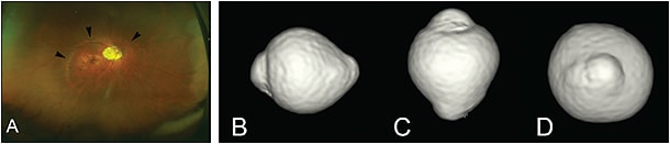 Figure 9. Narrow, macular staphyloma (modified from reference #4). A. In widefield fundus image, the upper edge of narrow staphyloma is observed as pigmentary abnormalities (arrowheads). B through D. 3D MRI images show posterior outpouching of narrow area of posterior segment of the eye in the image viewed from the inferior (B), nasal (C), and back views (D). The eye looks like a strawberry.