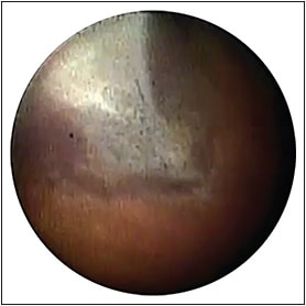 Figure 2. Endoscopic view of completely detached retina, rolled into a tube, adherent to the eye wall and extending from the disc to the pars plana. Note bare retinal pigment epithelium that gave the illusion of a red reflex, attached retina, through a cloudy cornea.