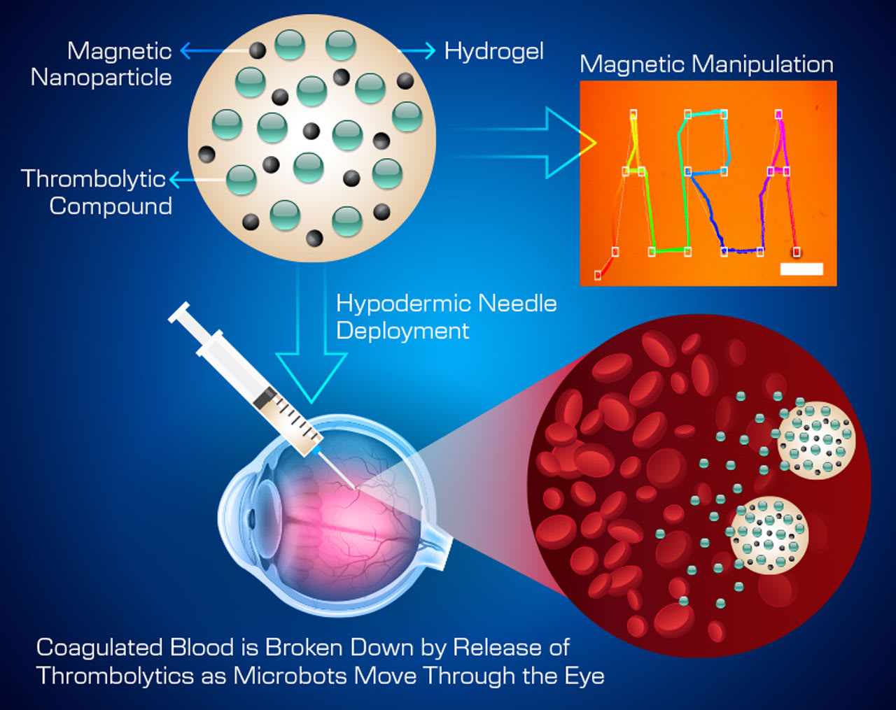 <p><strong>Figure 1. </strong>To treat vitreous hemorrhage, small-scale microrobots will be injected into the eye, where they will use targeted drug delivery to break down red blood cells.</p>