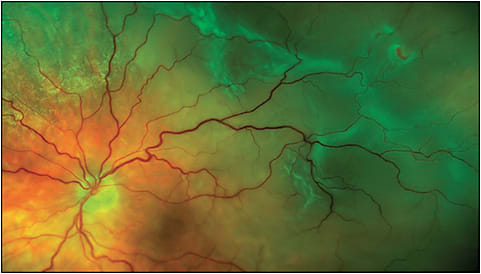 Figure 1. Superotemporal extrafoveal rhegmatogenous retinal detachment associated with horseshoe retinal tears at the 1:45 and 2 o’clock meridians in the vitreous base region.