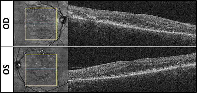 Figure 3. Optical coherence tomography of a patient who presented with a complaint of vision loss.