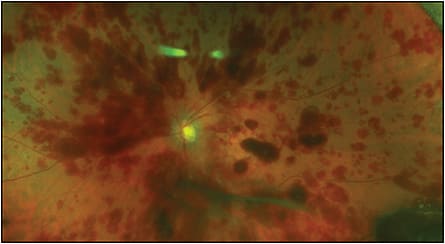 Figure 1. Fundus photo of the left eye of a patient showing diffuse preretinal and intraretinal hemorrhage 13 days after intravitreal stem cell injection. Collections of cells can be seen in the vitreous cavity below the optic nerve and in the lower right-hand corner. This retina detached 3 weeks later.
COURTESY OF THOMAS A. ALBINI, MD
