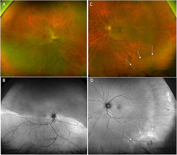 Figure 2. Widefield imaging of a 45-year-old female with a history of laser refractive surgery 2 decades earlier with decreased vision in the right eye. Inferior retinal detachment in the right (symptomatic) eye (A). Autofluorescence delineates the extend of the rhegmatogenous retinal detachment (B). Inferotemporal localized retinal detachment in the left (asymptomatic) eye outlined by arrows (C). Autofluorescence imaging shows subtle area of hyperautofluorescence corresponding to the rhegmatogenous retinal detachment (D).