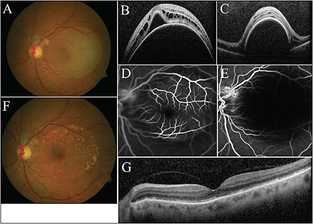 Figure 3. A 66-year-old white female with history of nAMD and PED in OD. The patient presented with 1 month of painless vision loss of OS with BCVA of 20/100. The exam showed large serous PED with associated peripapillary exudates (A). SD-OCT through the fovea (B) and the inferior edge of the PED (C) showed large domed serous PED with associated sub- and intraretinal fluid. Fluorescein angiography (D, E) shows large PED with no late leakage or pooling. Patient underwent 2 consecutive monthly intravitreal injections of aflibercept, and 2 months after initial presentation had 20/20 vision. Examination demonstrates near complete resolution of serous PED (F) with some residual exudates and near complete restoration of foveal contour (G).